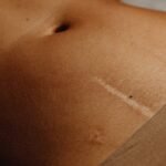 Navigating Recovery After a Tummy Tuck