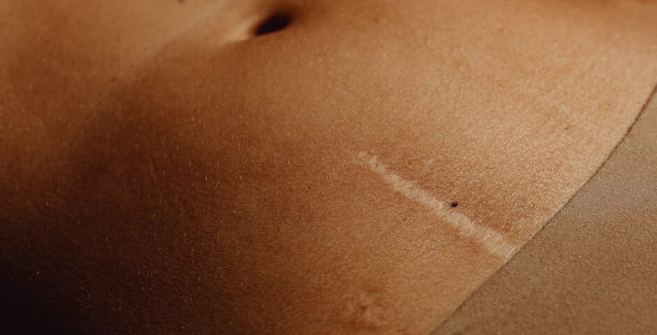 Navigating Recovery After a Tummy Tuck