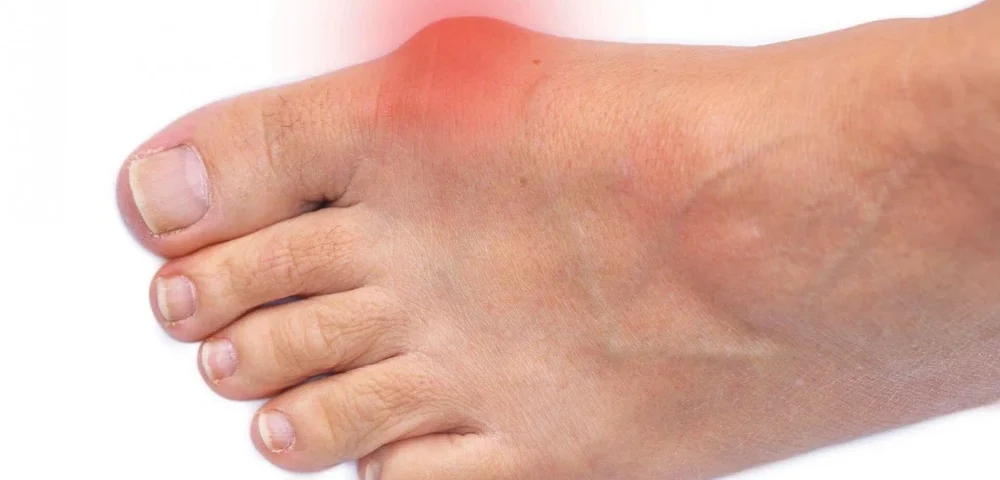 Exploring the Different Types of Bunions