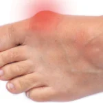 Exploring the Different Types of Bunions