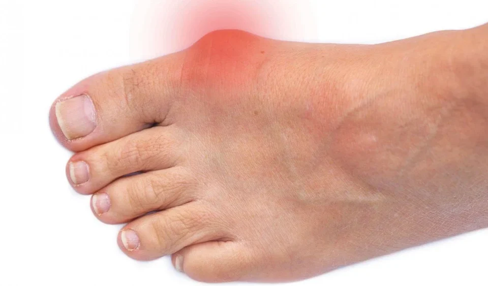 Exploring the Different Types of Bunions
