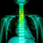 How Spine Neurosurgeons Approach Complex Spine Cases