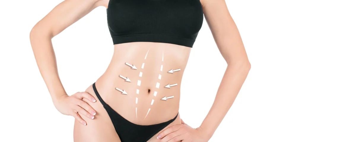 Preparing For a Tummy Tuck Consultation