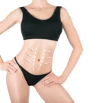 Preparing For a Tummy Tuck Consultation