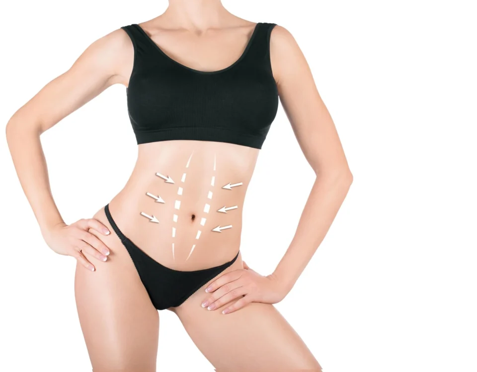Preparing For a Tummy Tuck Consultation
