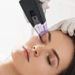 Using Morpheus8 to Achieve Flawless Skin