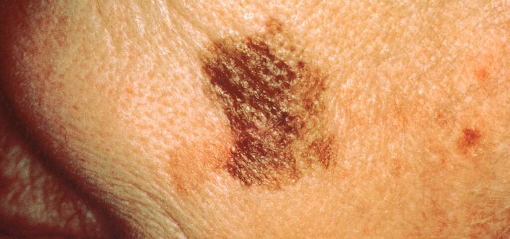 What You Need to Know About Skin Cancer