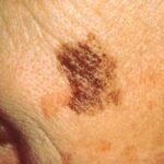 What You Need to Know About Skin Cancer