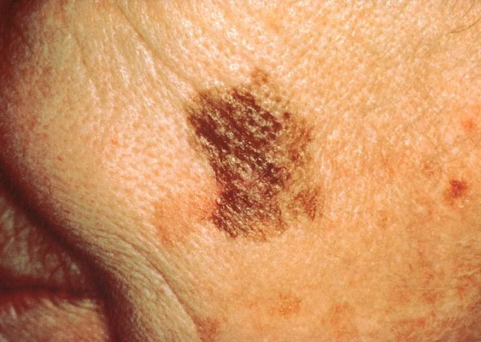 What You Need to Know About Skin Cancer