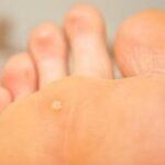 Why Do We Get Plantar Warts?