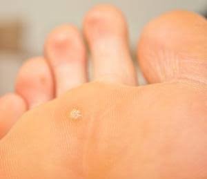 Why Do We Get Plantar Warts?