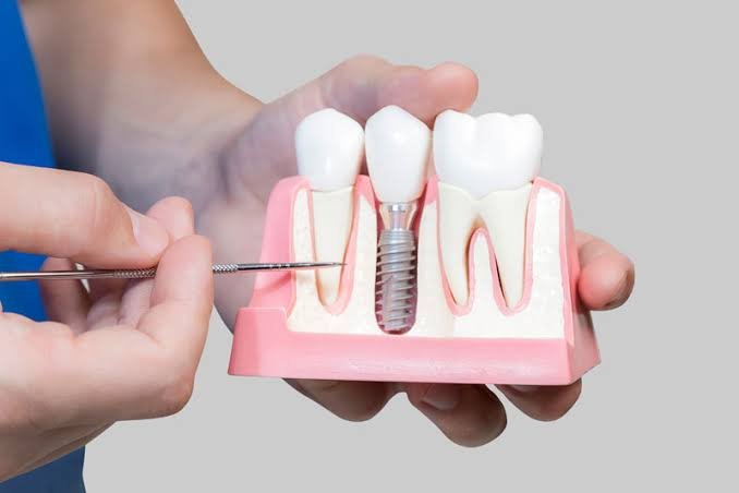 Dental Implants