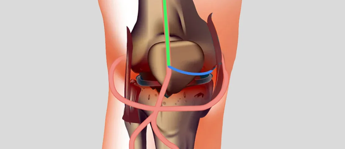 What You Need To Know About Knee Pain