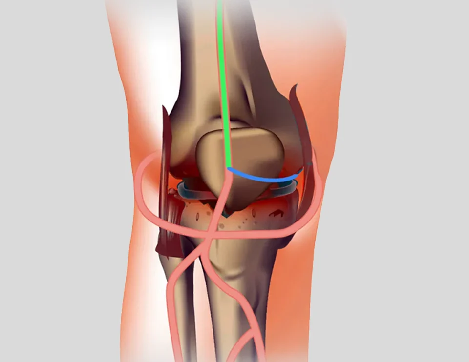 What You Need To Know About Knee Pain